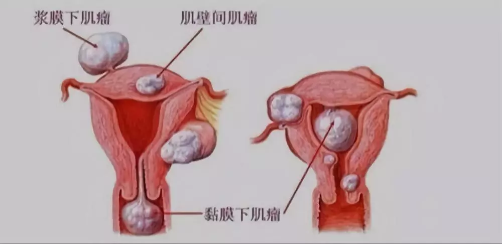 通常,子宫肌瘤根据生长部位不同分为子宫体肌瘤(95%)和子宫颈肌瘤(5%)