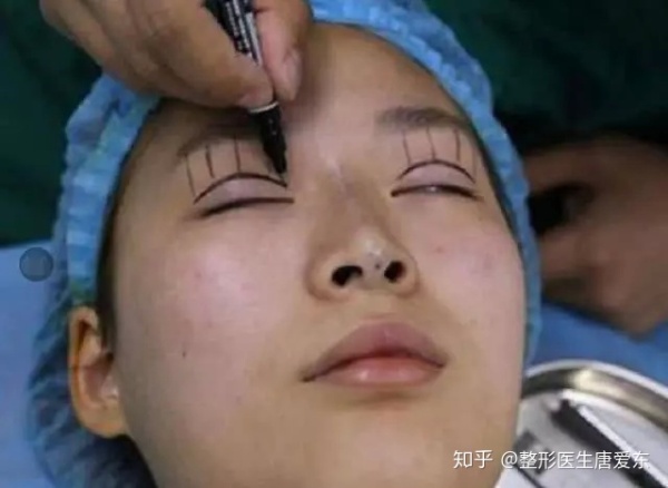 通過手術割雙眼皮的人老了之後眼皮會怎麼樣 時尚 第3張