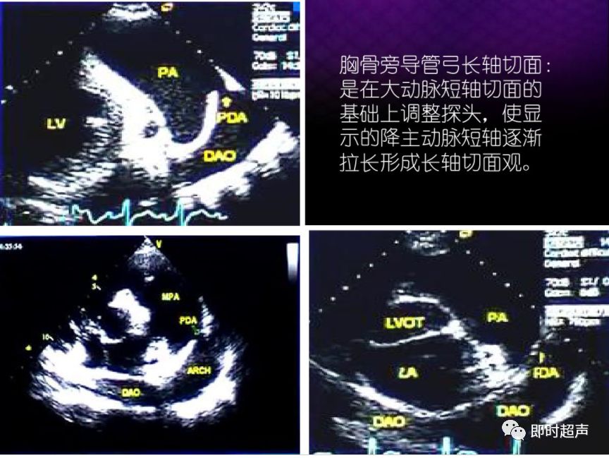 动脉导管未闭超声诊断