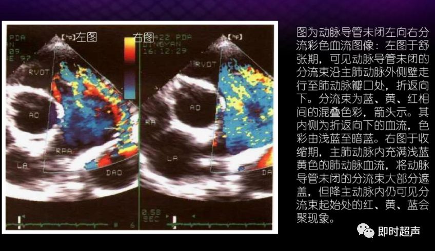 动脉导管未闭超声诊断