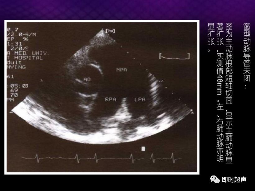 动脉导管未闭超声诊断