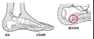 腳後跟總疼是怎麼回事？ 健康 第1張