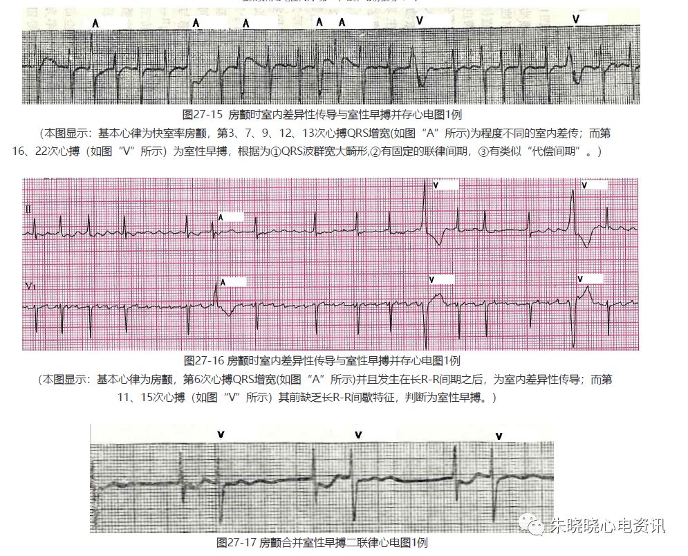 【临床实用心电图入门】 第二十七讲:心房颤动(一)