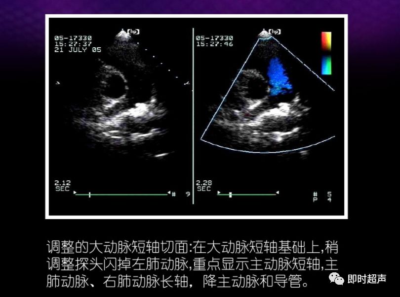 动脉导管未闭超声诊断