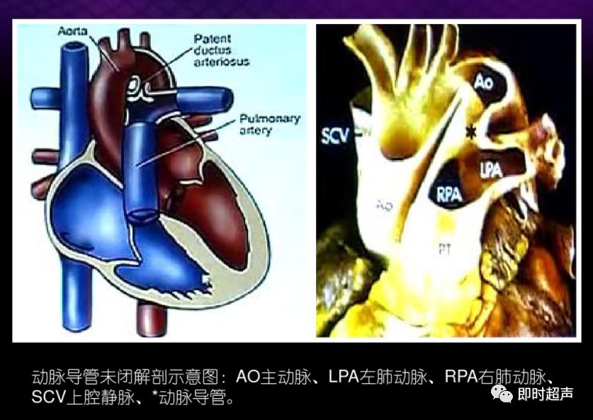 动脉导管未闭超声诊断