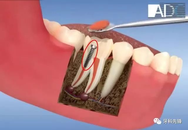 给牙齿打桩,是指在牙齿缺损较大,或因为外伤等原因只剩下牙根时,因剩