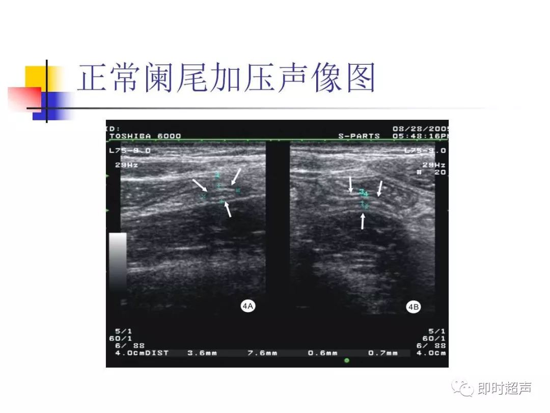 阑尾超声扫差在急腹症中的应用