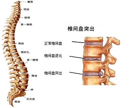 腰椎间盘突出有救了,家有腰腿疼痛的人,记得存起来,简单实用