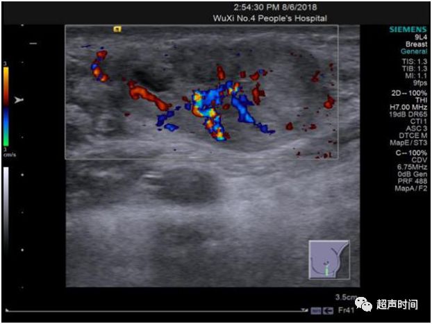 超声高手进阶乳腺分叶状肿瘤