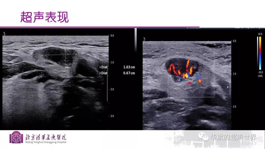 病例分析与文献学习:igg4相关性涎腺炎