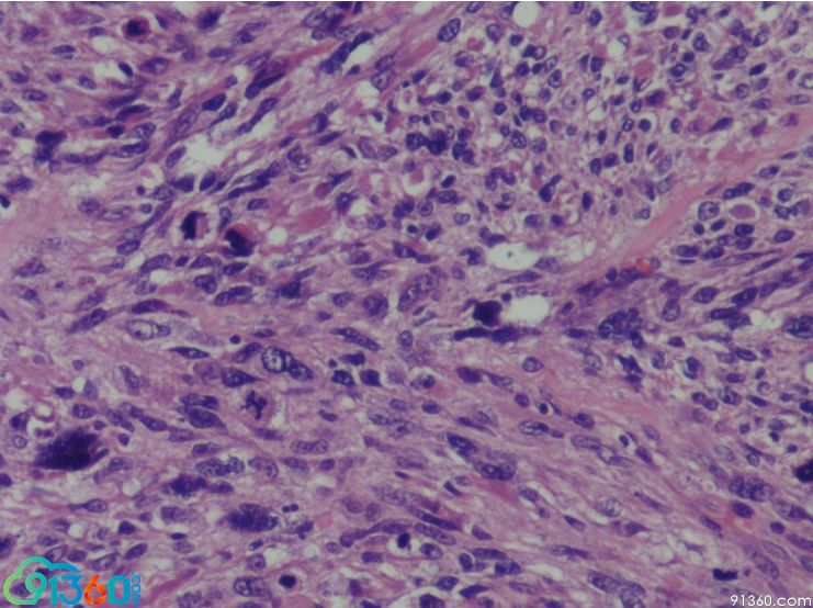 病理诊断:原发性胚胎性横纹肌肉瘤,急变