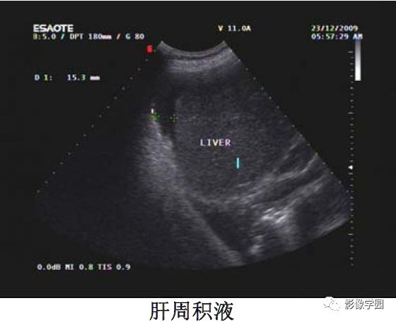 腹腔积液的良恶性表现与鉴别