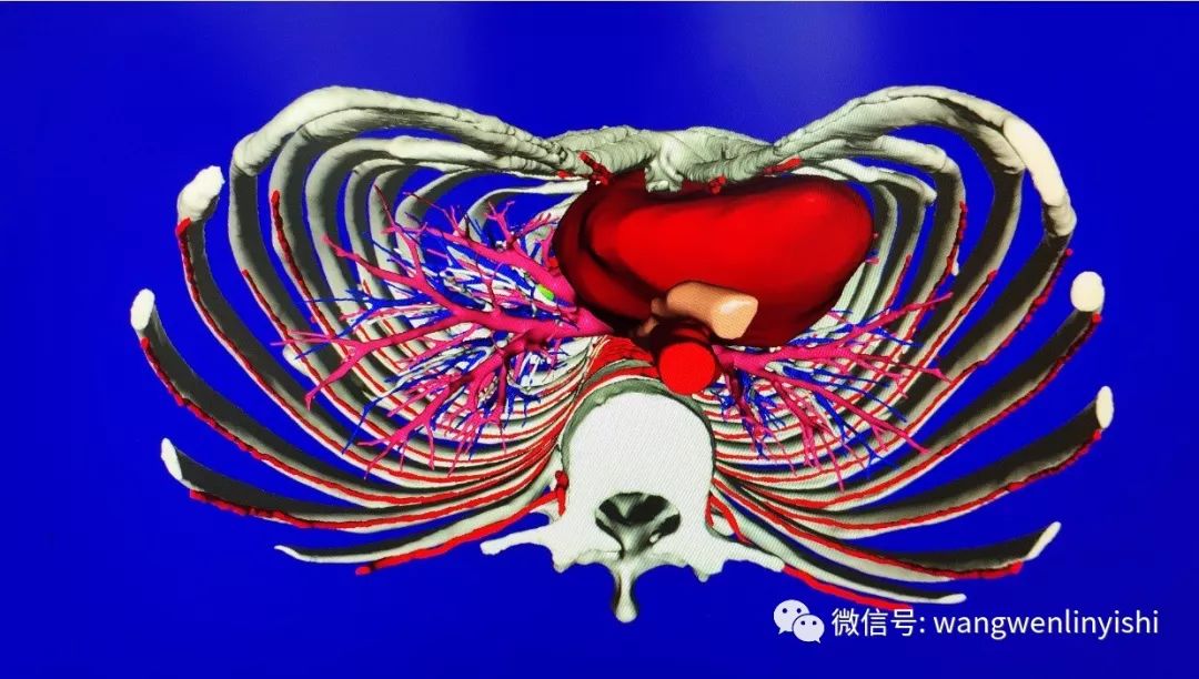 失败沟状胸手术之二次手术