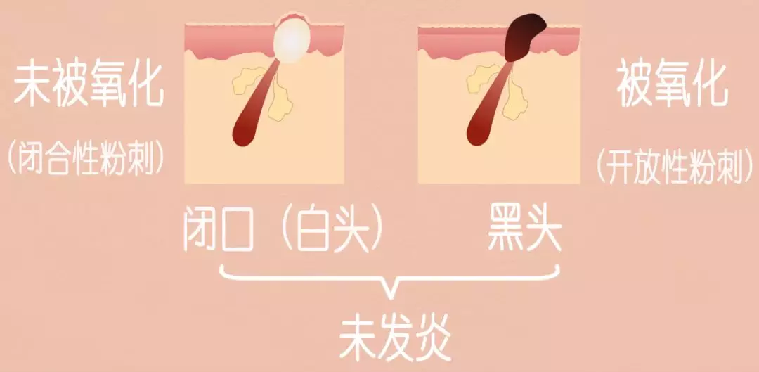 再加上老废的角质细胞堵塞毛孔,从而导致这过多的皮脂没有办法顺利的