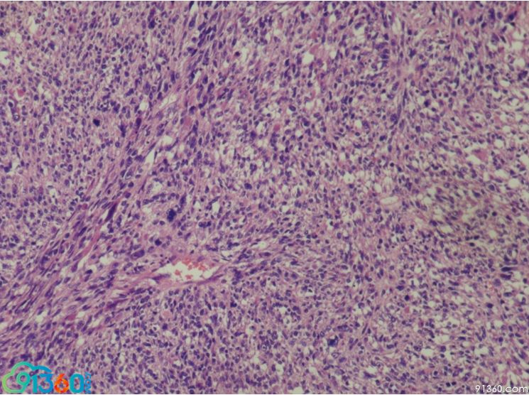 病理诊断:原发性胚胎性横纹肌肉瘤,急变