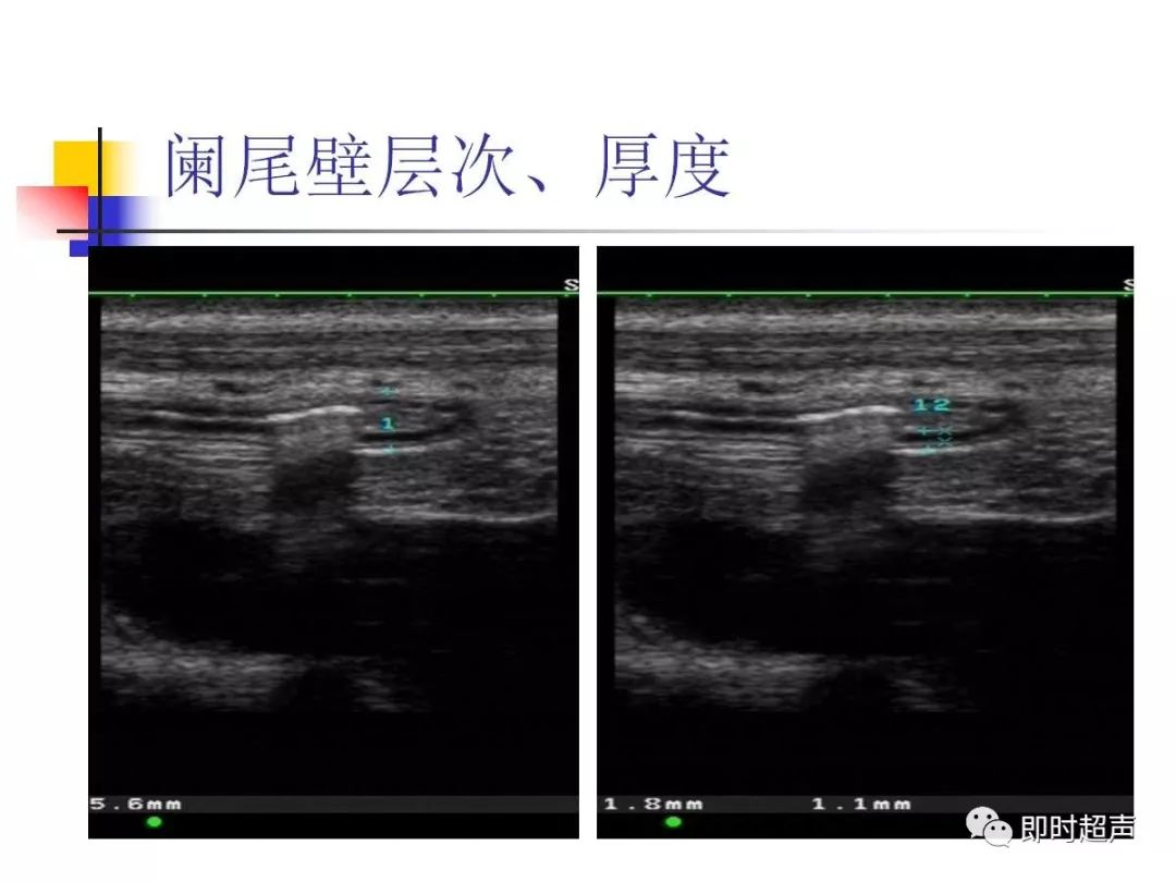 阑尾超声扫差在急腹症中的应用