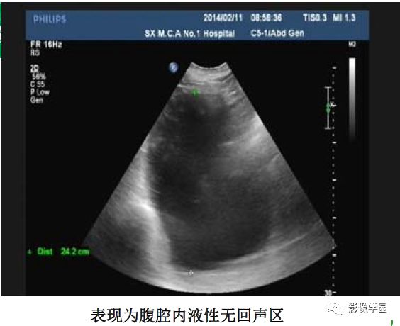 腹腔积液的良恶性表现与鉴别