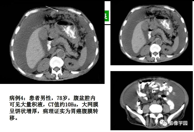 腹腔积液的良恶性表现与鉴别