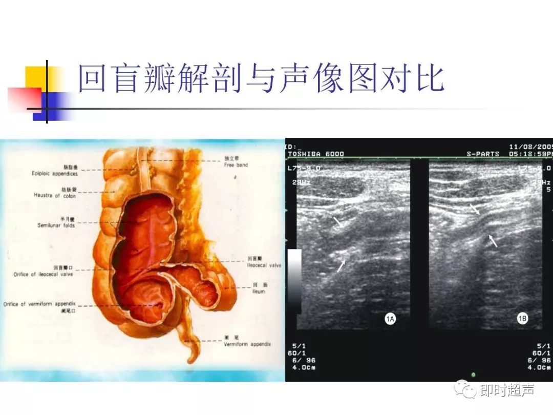 阑尾超声扫差在急腹症中的应用