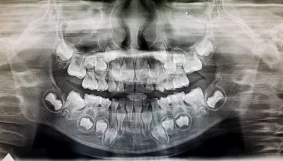 全景片下的儿童牙齿排列, 看似小怪兽,实际上井然有序!