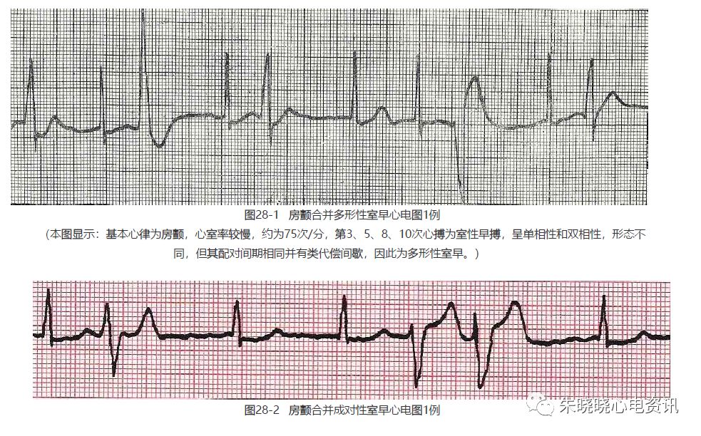 如房颤合并室早连续超过3次,即称为房颤合并短暂性室性心动过速及室