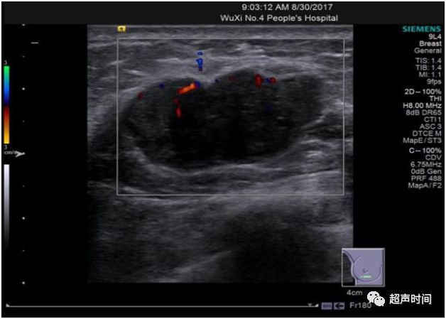超声高手进阶:乳腺分叶状肿瘤