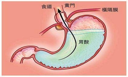 重视这几点,轻松改善胃酸老毛病