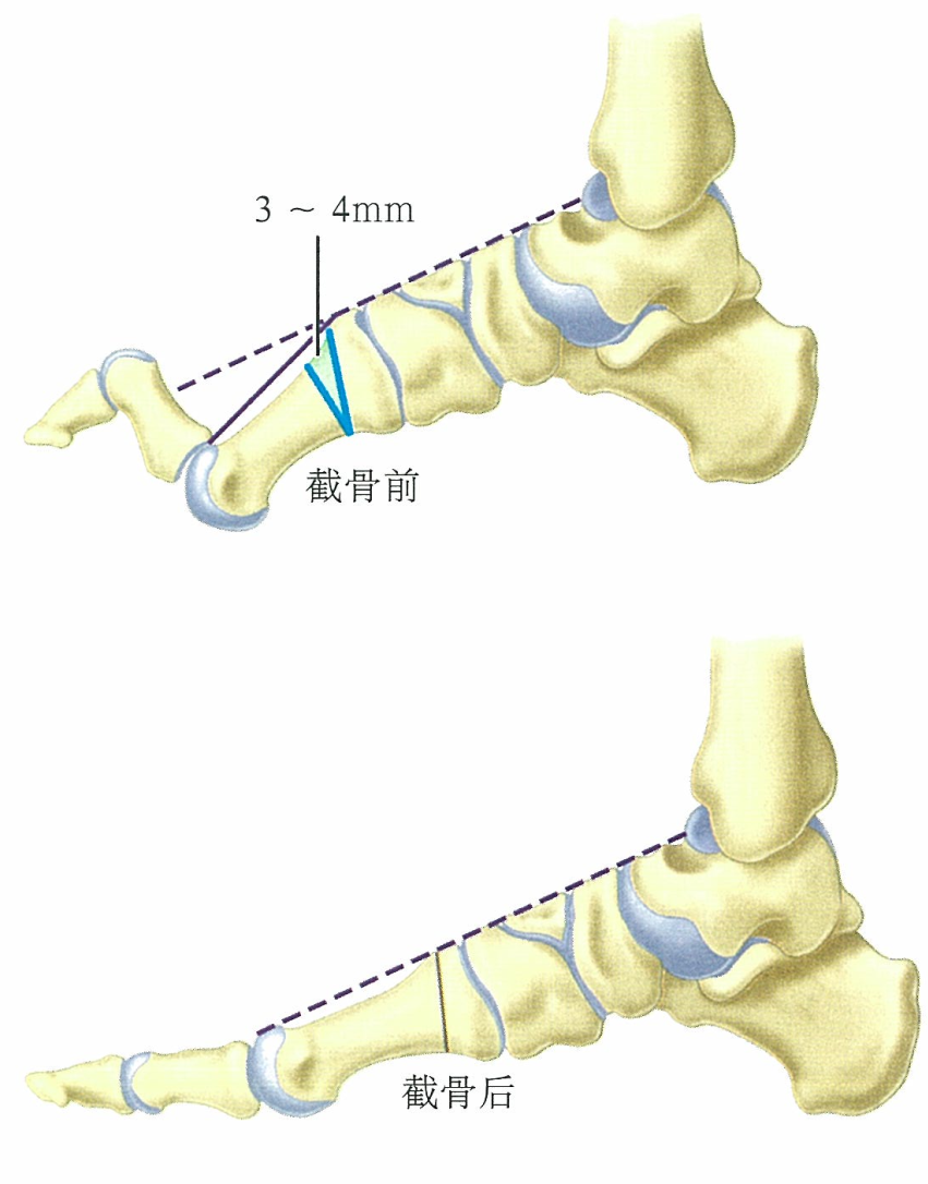 高弓足畸形诊治与病例分享多图详解