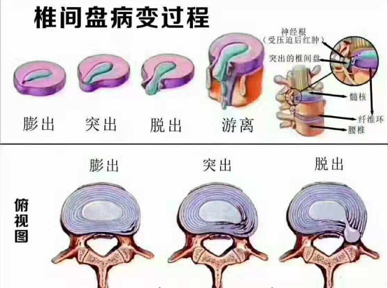 腰椎间盘病变程度不同,治疗手段也不同