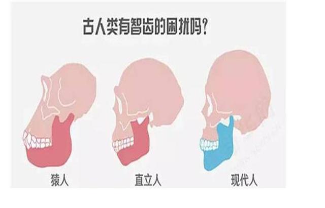 「醫生手記」智齒發炎，到底要不要拔除？ 未分類 第3張