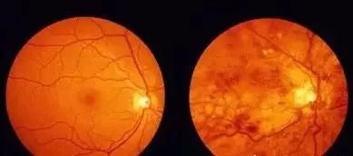 警惕!眼轴每延长1mm,患青光眼的概率增加26%