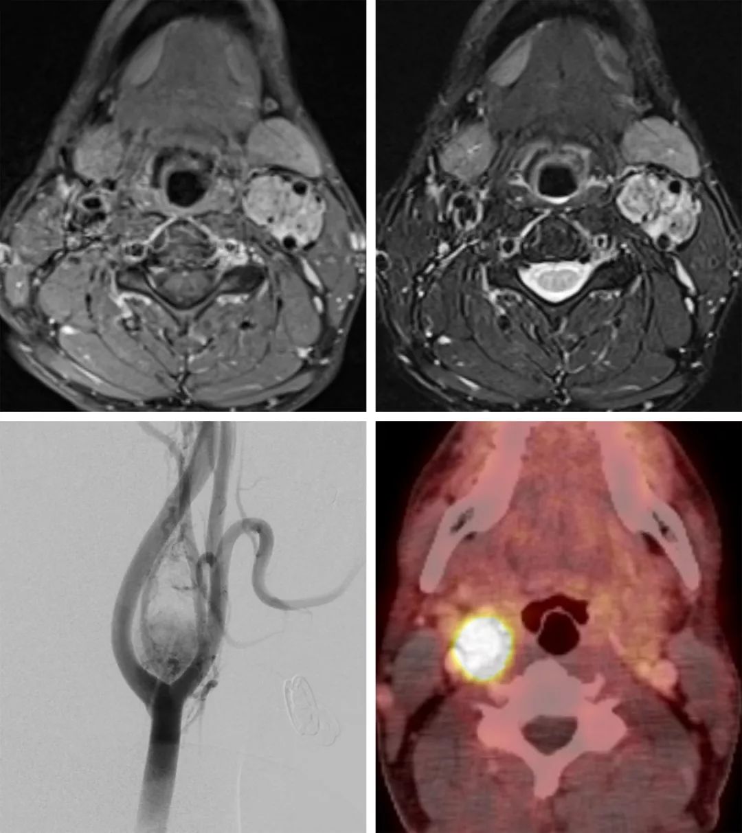 这是颈动脉体副神经节瘤的高发位置,在t2加权相表现为高信号,由于其