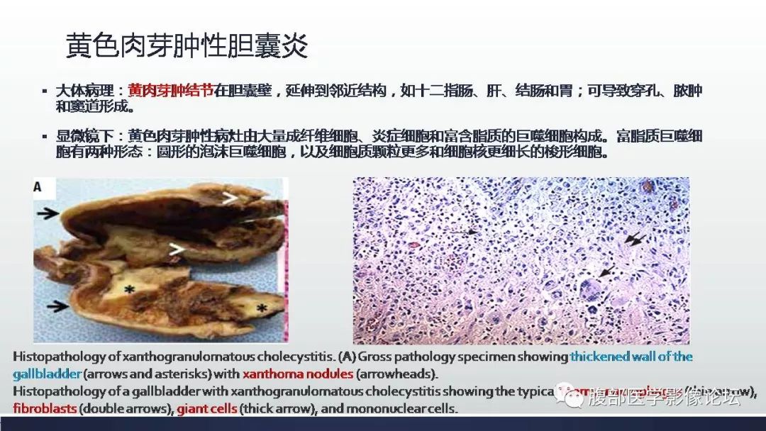 黄色肉芽肿性胆囊炎诊断及鉴别诊断