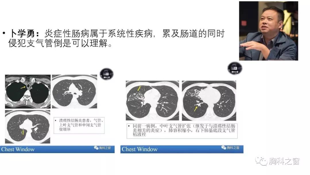 克罗恩病肺病表现