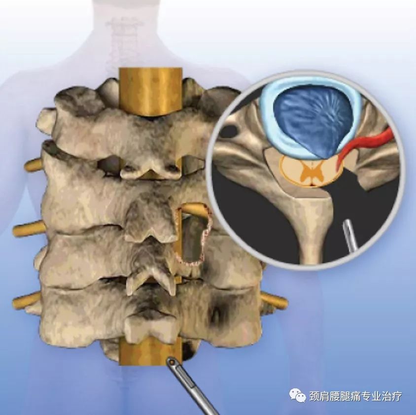 中英文字幕颈后路椎板切开术posteriorcervicallaminotomy