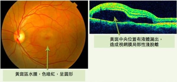 出了问题,造成脱离,即是中性型浆液型脉络膜视网膜病变,简称"中浆"