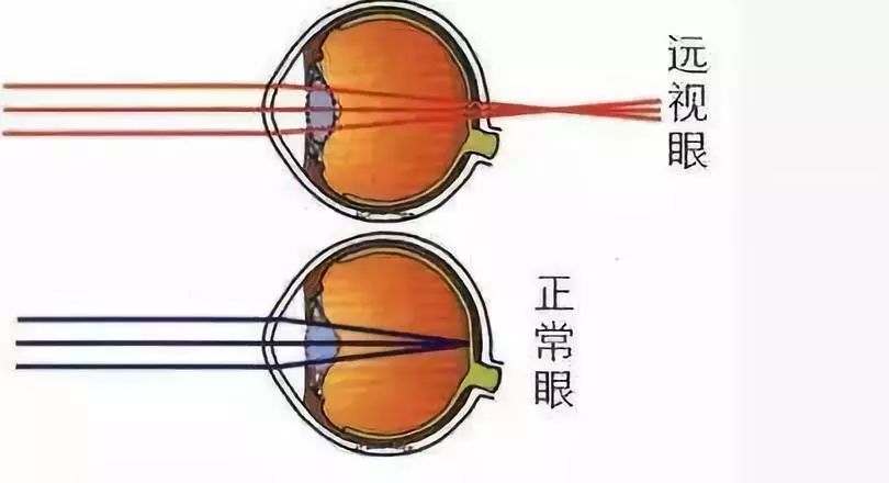 的一种屈光状态,当眼球的屈光力不足或其眼轴长度不足时就产生远视
