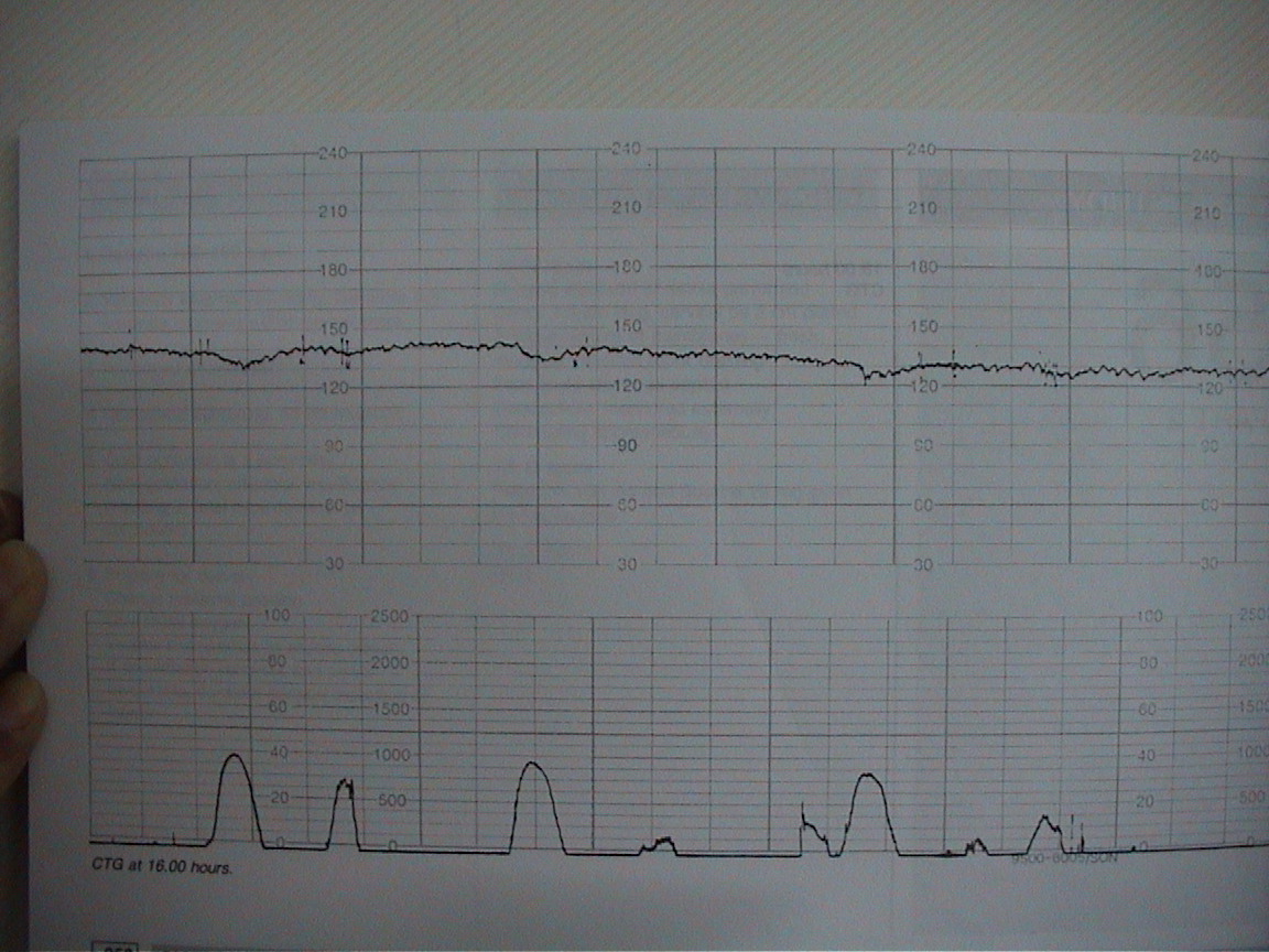 医生教你看懂胎心监护报告单