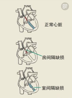 让"心漏"的宝宝不再缺爱:先天性心脏病重在找准时机,选对方案