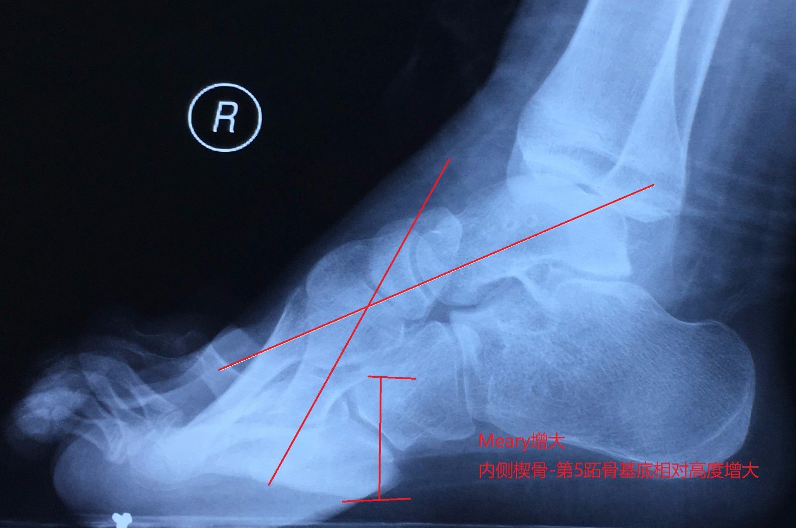 辅助检查:meary角增大,内侧楔骨-第5跖骨基底相对高度增大.