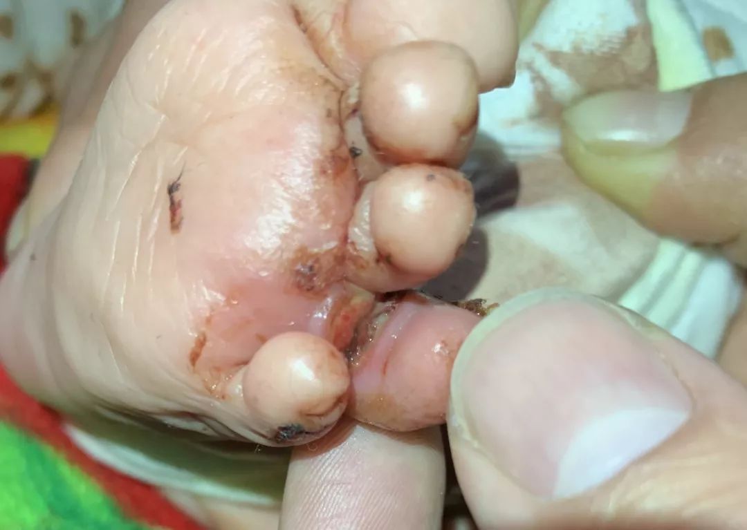 腳趾被襪子線頭纏繞壞死！新化4個月女嬰要截趾？ 未分類 第2張