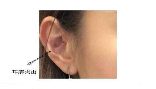 面相耳朵案例详解:九种不同的耳朵,九种不同的出生_耳垂