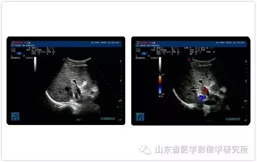 山東省醫學影像學研究所科室簡介（三）——超聲介入診療研究室 健康 第8張