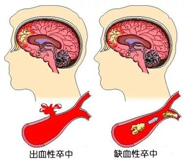 每21秒死一個人，它才是人類的第一殺手！想要「刀下留人」？你得知道這些 健康 第1張