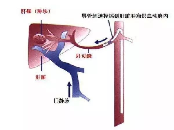 一起来认识肝血管瘤?