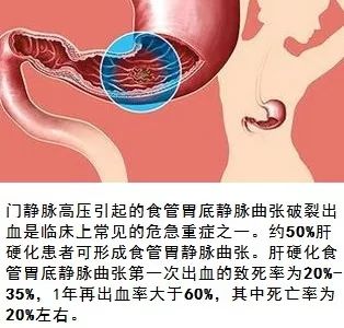 肝硬化病人口吐血_肝硬化病人图片