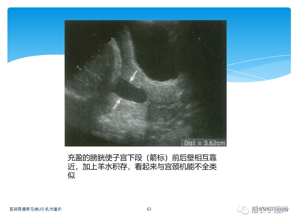 超声微课堂宫颈阴道常见病超声诊断宫颈机能不全超声检查