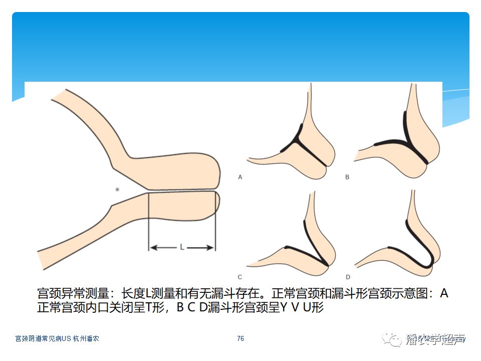 【超声微课堂】宫颈阴道常见病超声诊断:宫颈机能不全