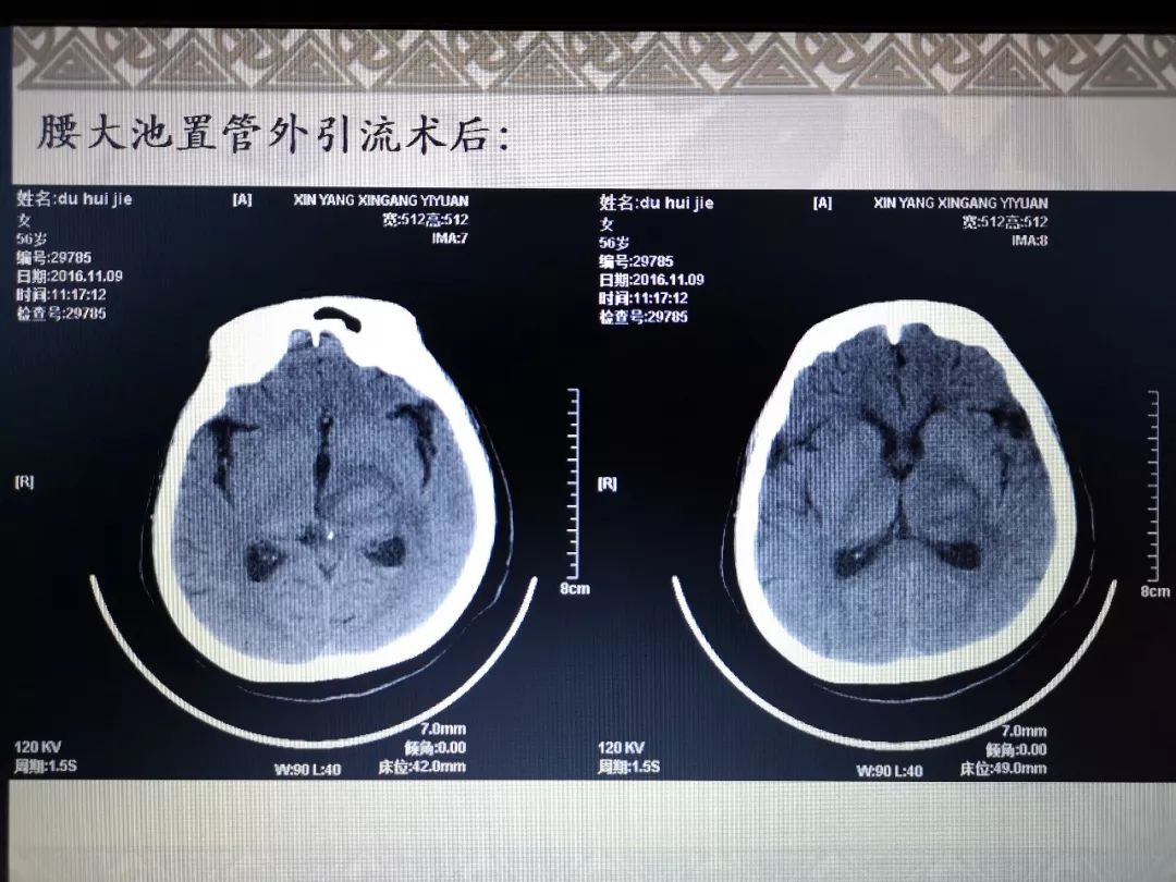 出现梗阻性脑积水在各类脑积水脑室腹腔分流术,三维钛板颅骨修补手术