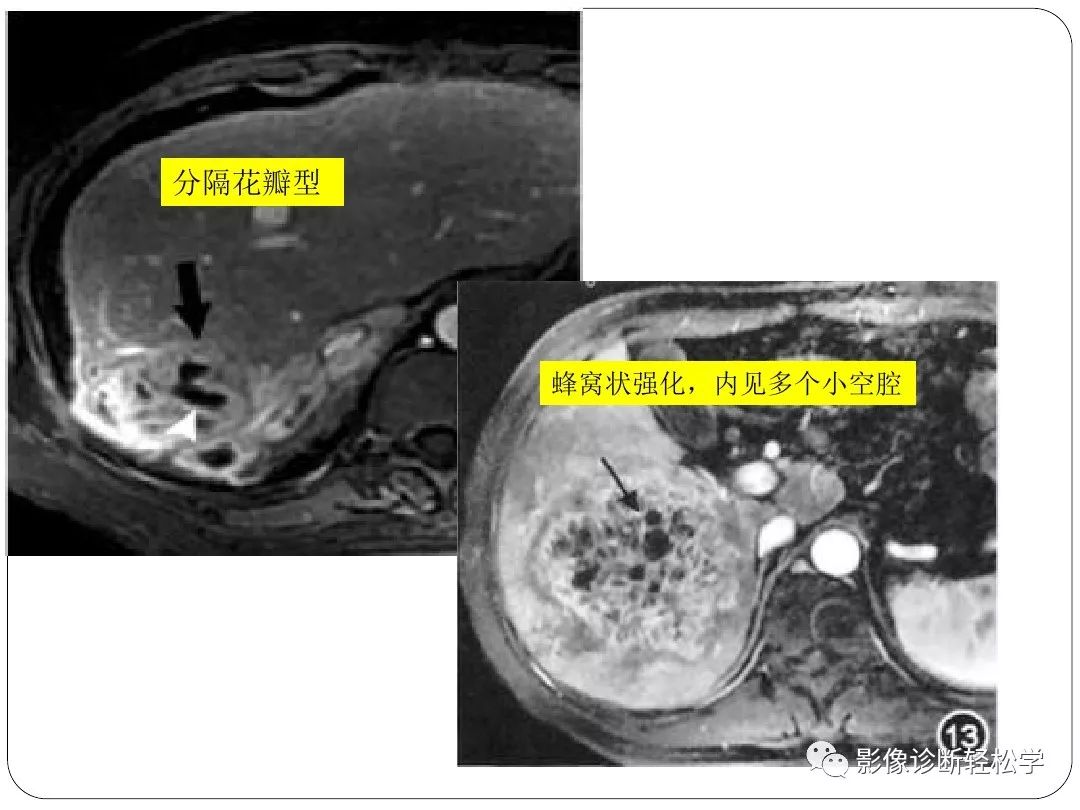 【每日一例| 480例】肝脓肿的诊断及鉴别